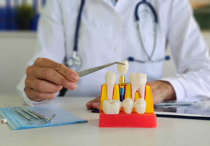 dental implants Sunnyvale