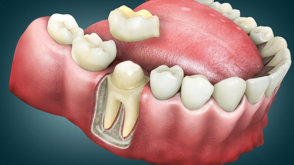 dental crowns sunnyvale